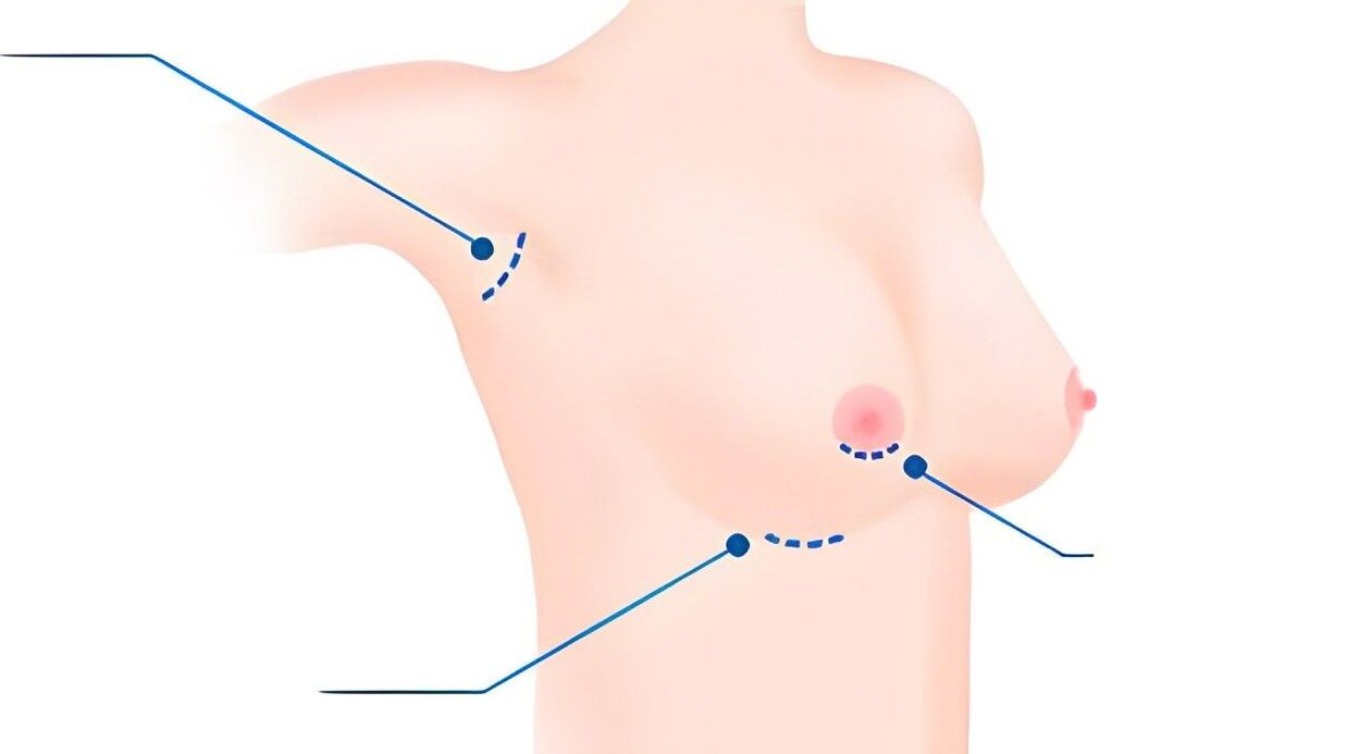 Types of sizes for breast augmentation